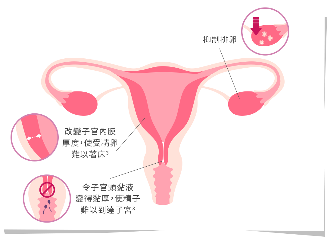 顯示Mercilon 美意避避孕藥如何發揮作用的原理